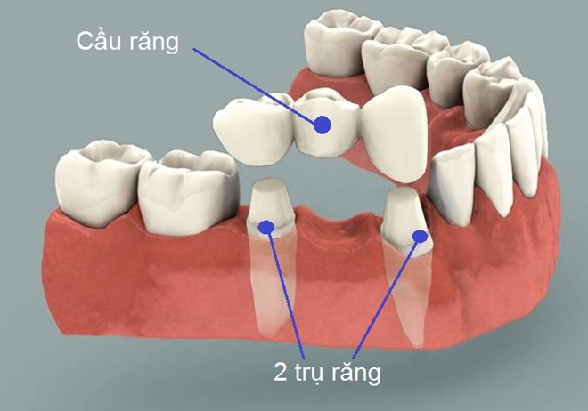 cầu răng sứ và cấy ghép implant