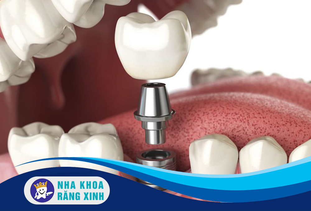 cấy ghép implant là giải pháp tối ưu cho người mất răng lâu năm