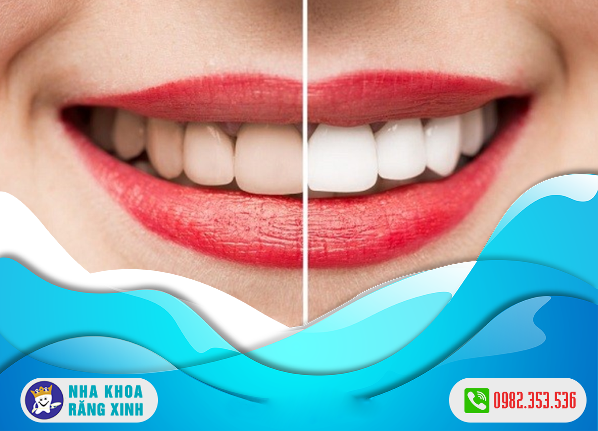 Tẩy trắng răng bị nhiễm kháng sinh có những đặc điểm gì ?