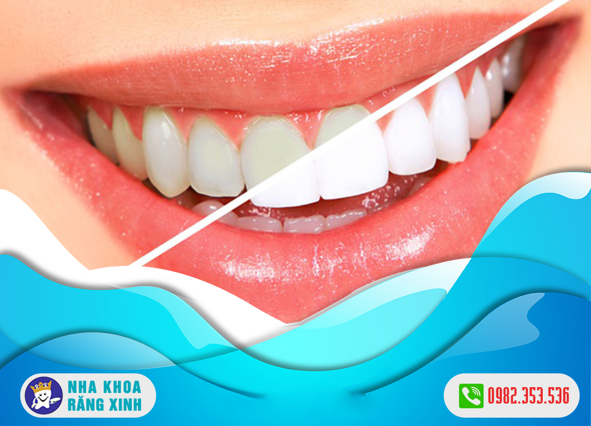 Tẩy trắng răng bị nhiễm kháng sinh có những đặc điểm gì ?
