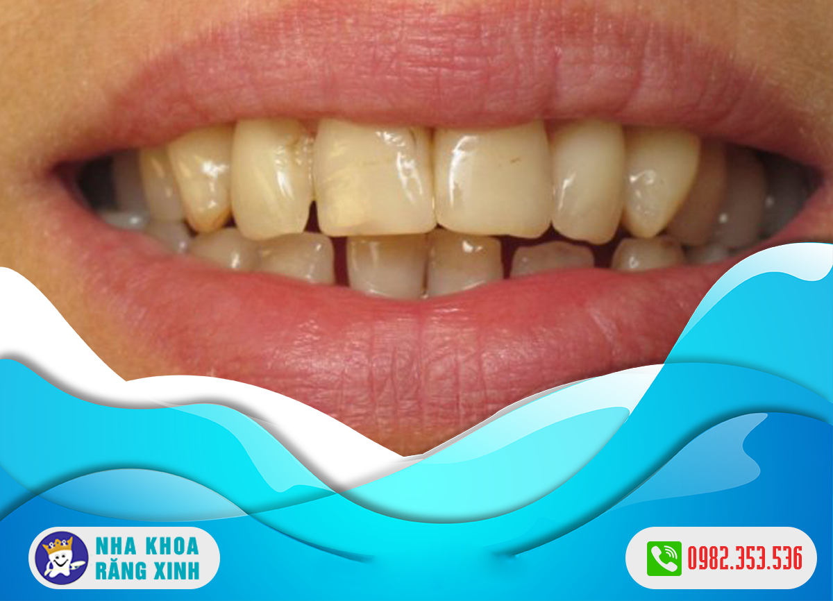 Men răng đen là biểu hiện của bệnh lý răng miệng nào