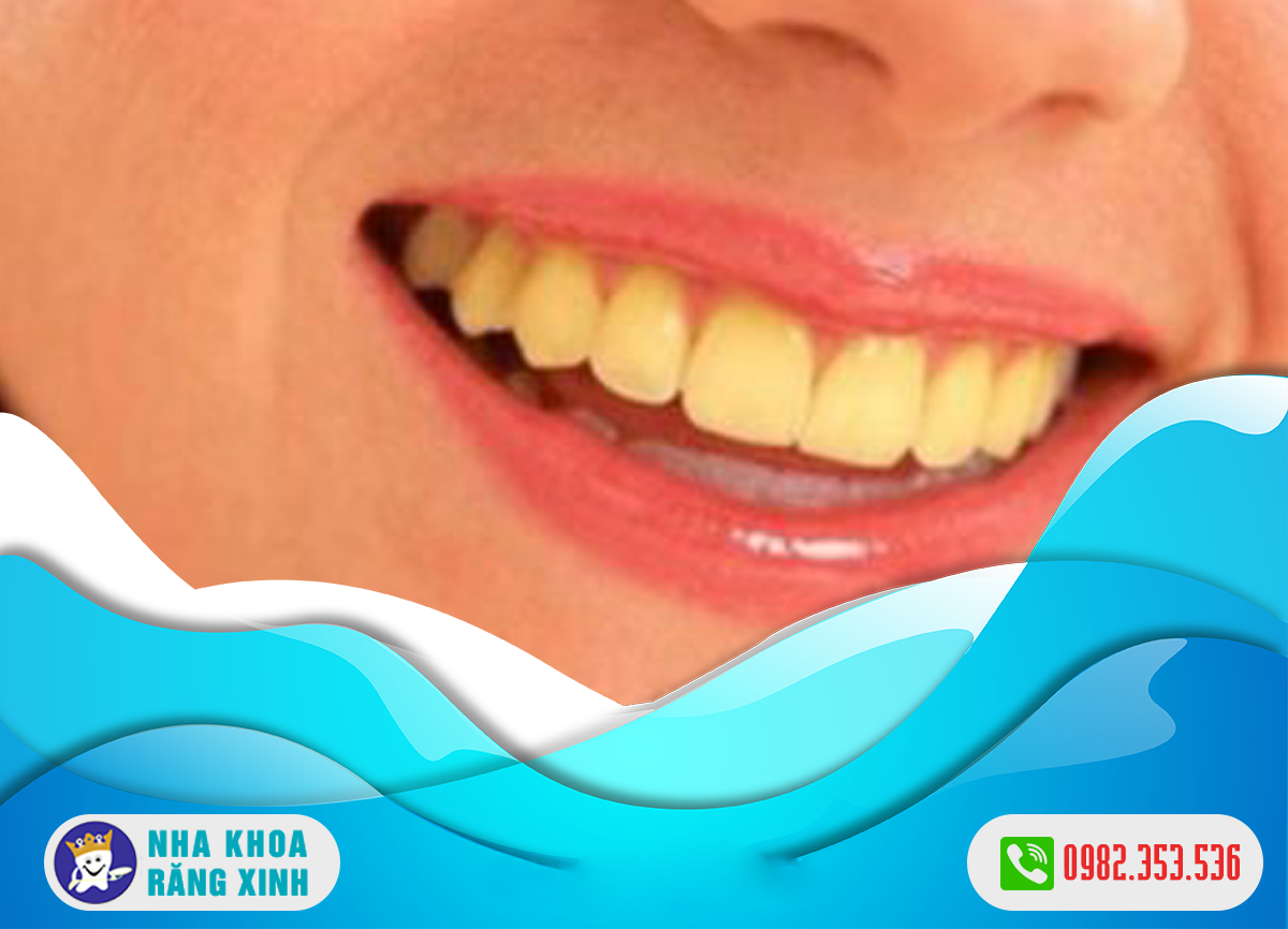 Men răng đen là biểu hiện của bệnh lý răng miệng nào